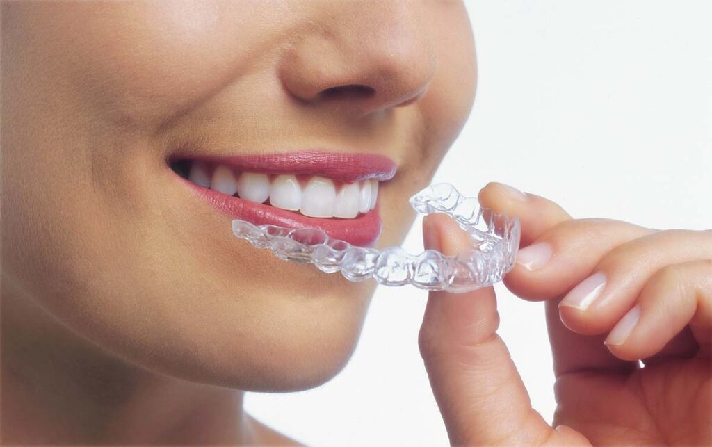 Woman inserting clear Invisalign aligner 