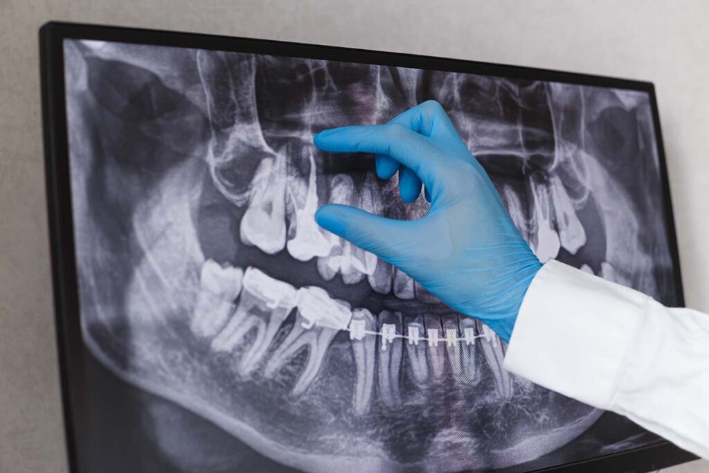 Dentist explaining root canal procedure with X-ray