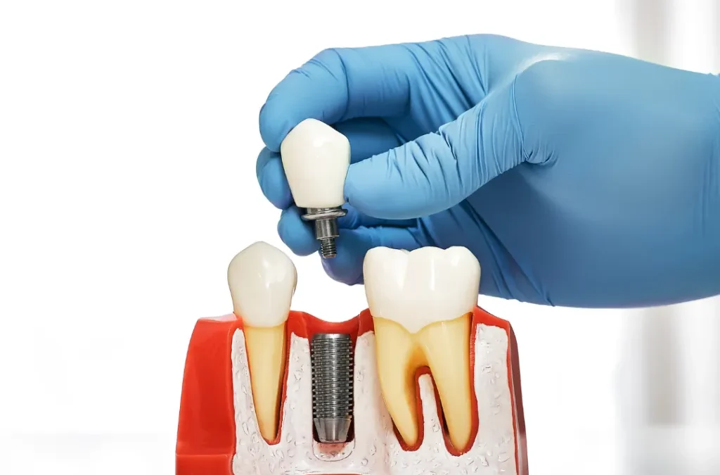 Dental Implants in Sacramento: Your Permanent Answer to Missing Teeth