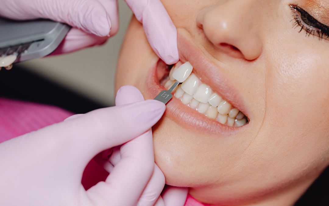 Transform Your Smile with Veneers at GT Dental Studio