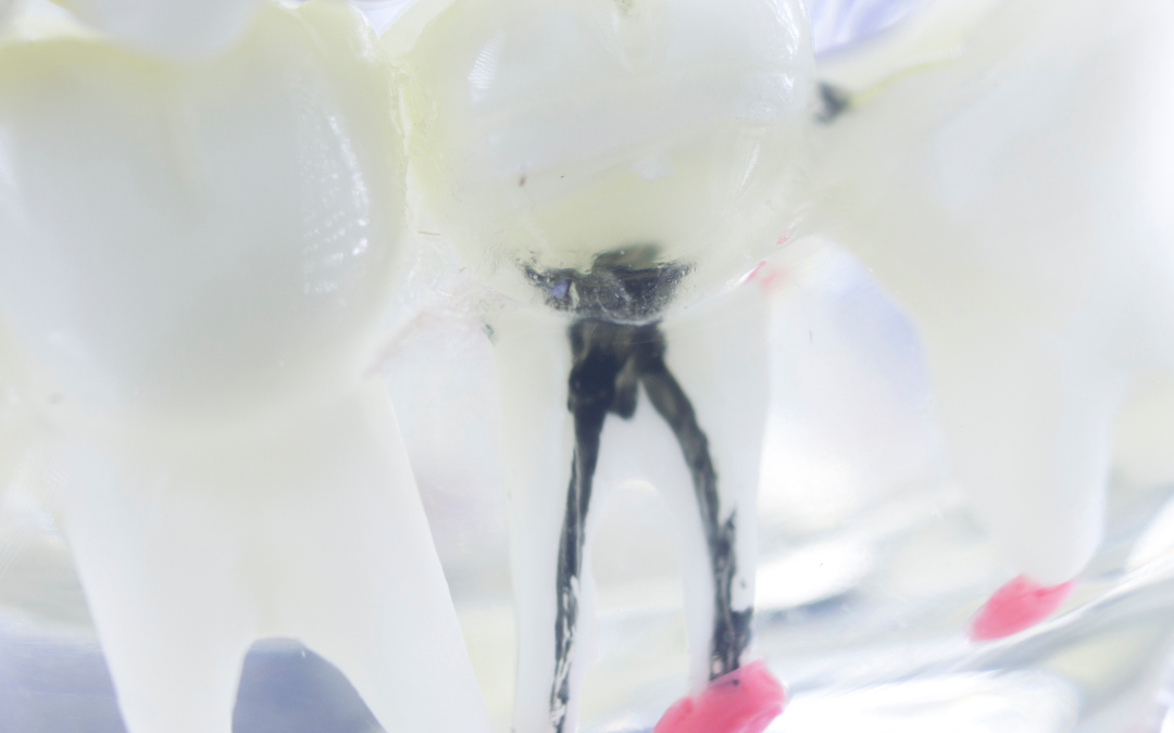 Root Canals Demystified: A Comprehensive Insight